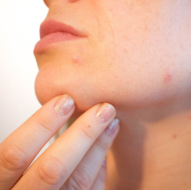 Stop the Quick Fix: Clearing Skin Takes Time