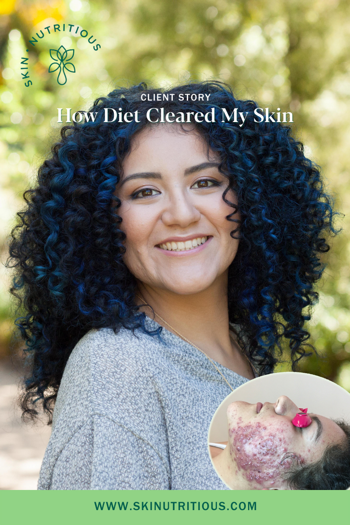 How Diet Changes Cleared Diana's Cystic Acne in 12 Weeks