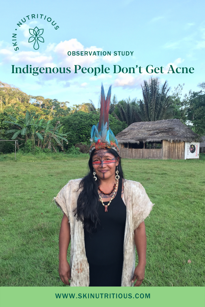 Why Indigenous People Don't Have Acne